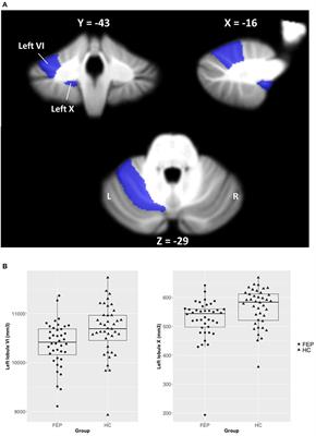 Cerebellar Structural Abnormalities Associated With Cognitive Function in Patients With First-Episode Psychosis